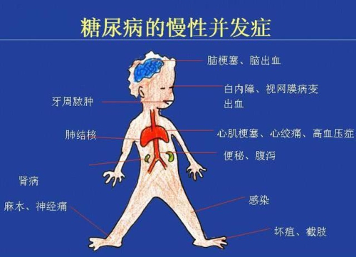 同是糖尿病母子控糖天壤之别 新桥医院专家这么说